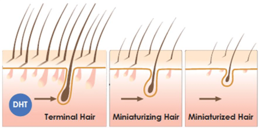 DHT medføre rhårtab. Processen kaldes miniaturisering og sker hos mænd, der bliver skaldet. Hårspecialist og Læge Ulrik Knap