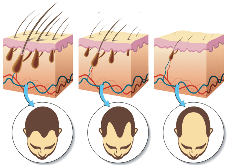 Hårrødderne mister efterhånden deres blodforsyning i takt med udvikling af hårtabet. Dette sker som led i miniaturiseringen. Hårspecialist Læge Ulrik Knap