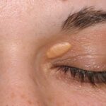 Kolesterol pletter omkring øjnene xanthelasma kan fjernes med laser læge ulrik knap