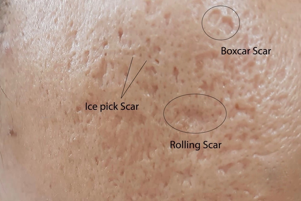 Ice Pick Scars: Den mest almindelige Form for Akne Ar