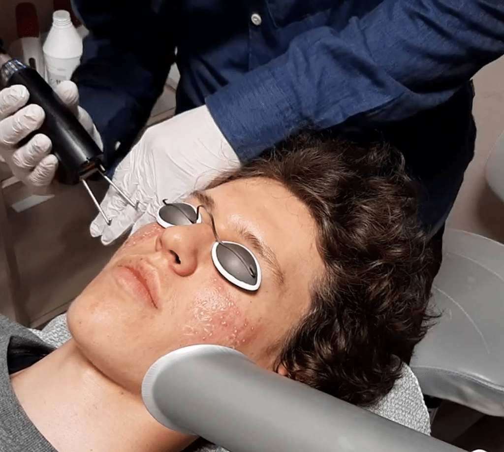 fraktioneret laser behandling ar efter akne læge ulrik knap