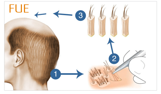 FUE hårtransplantation