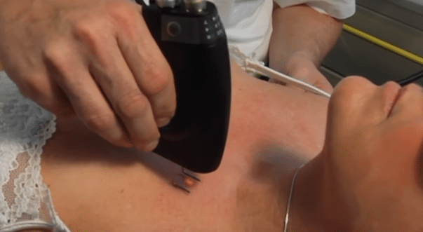 Laserbehandling bryst - Speciallæge Ulrik Knap
