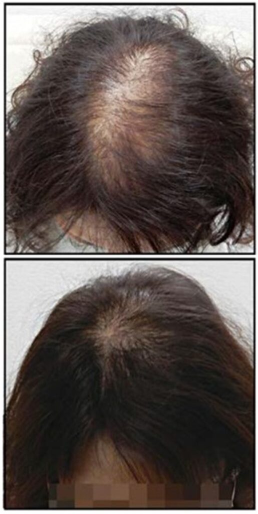 kvinde før og efter behandling af hormonelt hårtab