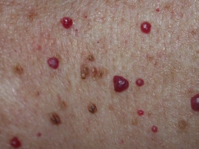 Effektiv fjernelse af røde knopper i huden, angiomer, hæmangiomer, kirsebærprikker, cherryspots med laser | Alba Privatklinik
