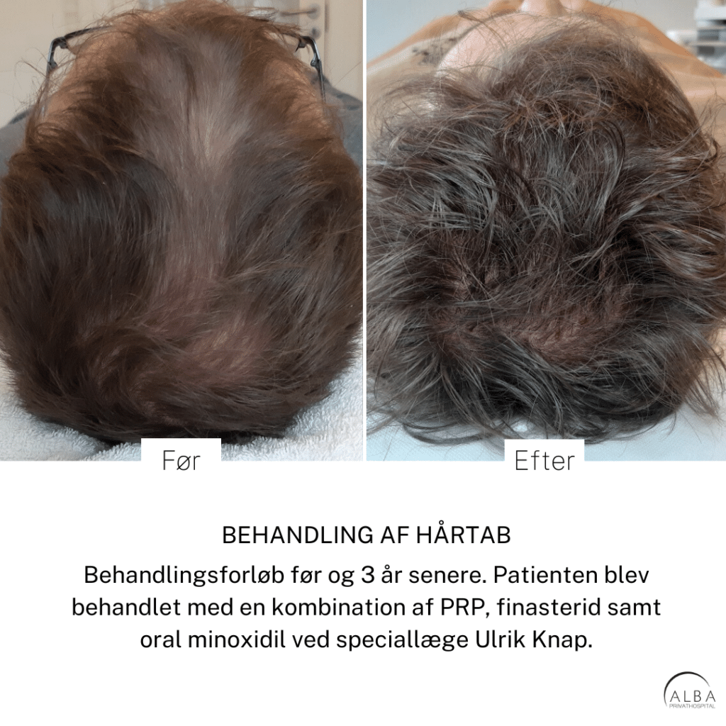 Behandling af hårtab med platelet-rich plasma, finasterid og minoxidil | Hudlæge Ulrik Knap