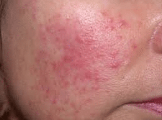 Rosacea - Det Røde Ansigt