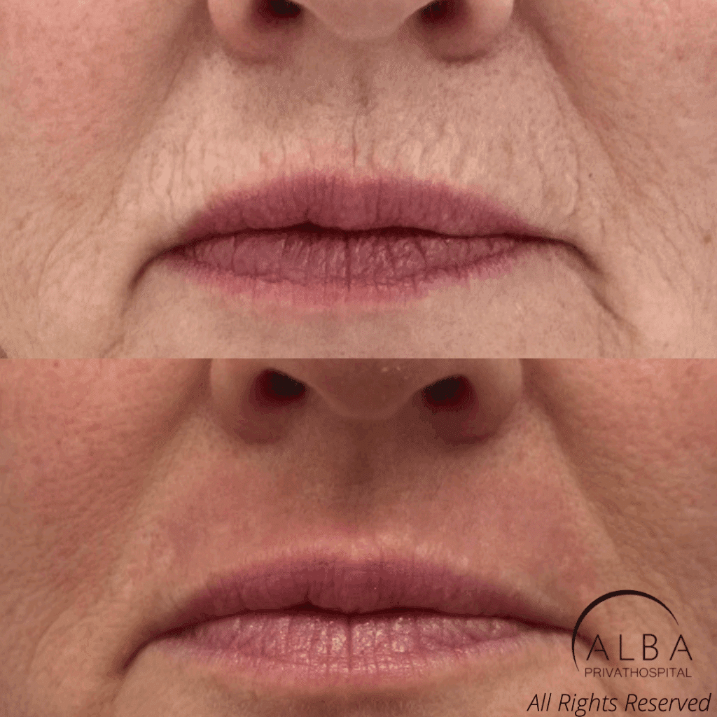 Behandling af rynker omkring mund & overlæbe med laser